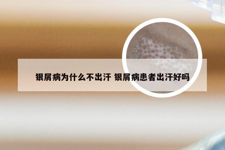 银屑病为什么不出汗 银屑病患者出汗好吗