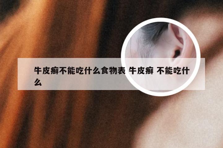 牛皮癣不能吃什么食物表 牛皮癣 不能吃什么