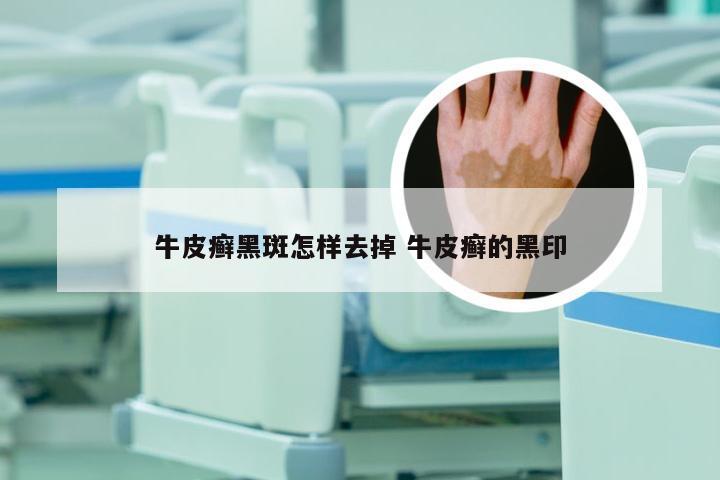 牛皮癣黑斑怎样去掉 牛皮癣的黑印