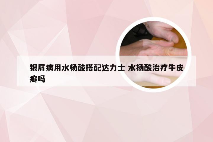 银屑病用水杨酸搭配达力士 水杨酸治疗牛皮癣吗