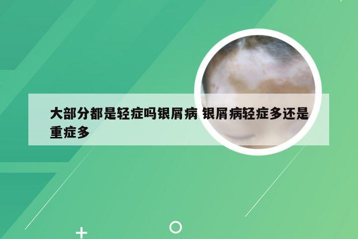 大部分都是轻症吗银屑病 银屑病轻症多还是重症多