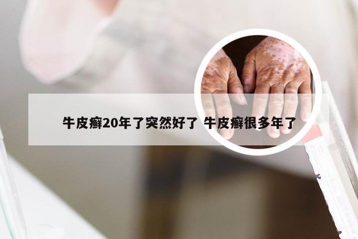 牛皮癣20年了突然好了 牛皮癣很多年了