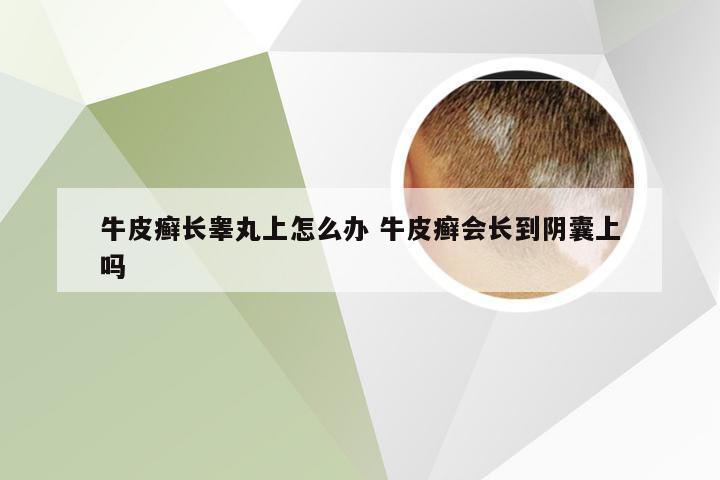 牛皮癣长睾丸上怎么办 牛皮癣会长到阴囊上吗