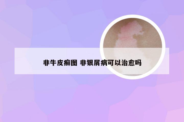 非牛皮癣图 非银屑病可以治愈吗