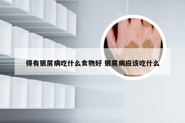 得有银屑病吃什么食物好 银屑病应该吃什么