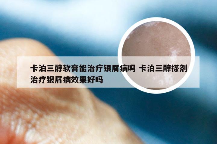 卡泊三醇软膏能治疗银屑病吗 卡泊三醇搽剂治疗银屑病效果好吗