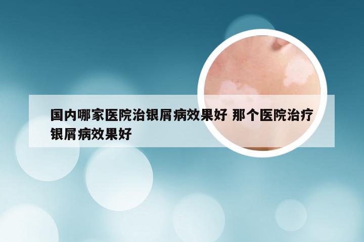 国内哪家医院治银屑病效果好 那个医院治疗银屑病效果好