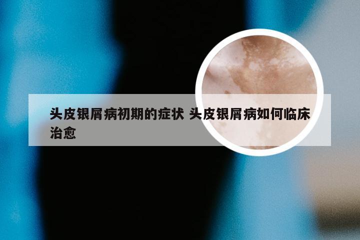 头皮银屑病初期的症状 头皮银屑病如何临床治愈