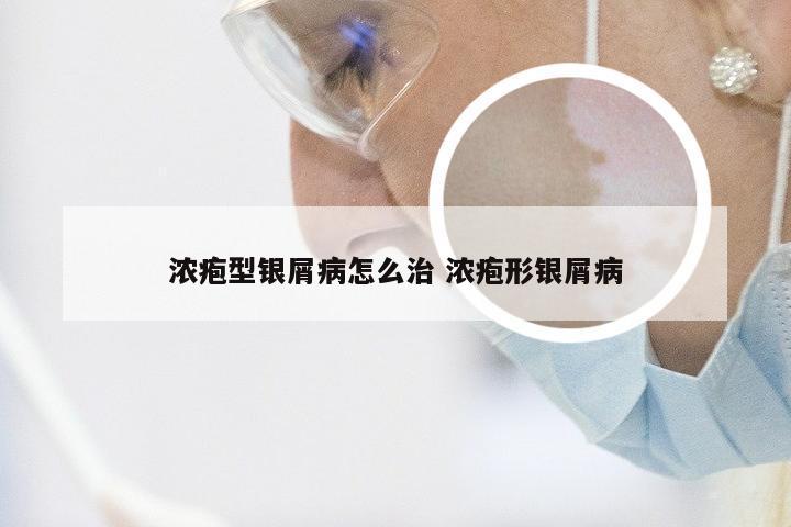 浓疱型银屑病怎么治 浓疱形银屑病