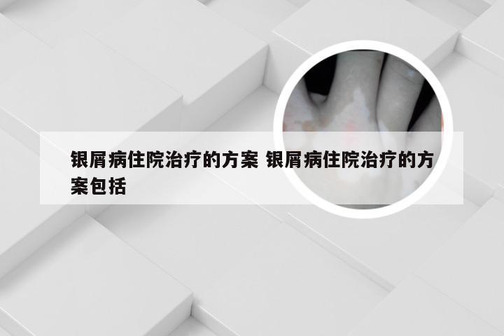 银屑病住院治疗的方案 银屑病住院治疗的方案包括