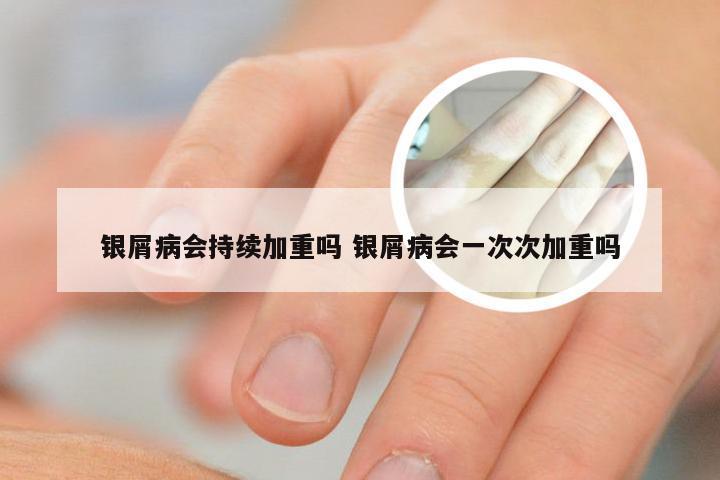 银屑病会持续加重吗 银屑病会一次次加重吗