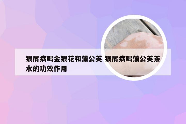 银屑病喝金银花和蒲公英 银屑病喝蒲公英茶水的功效作用