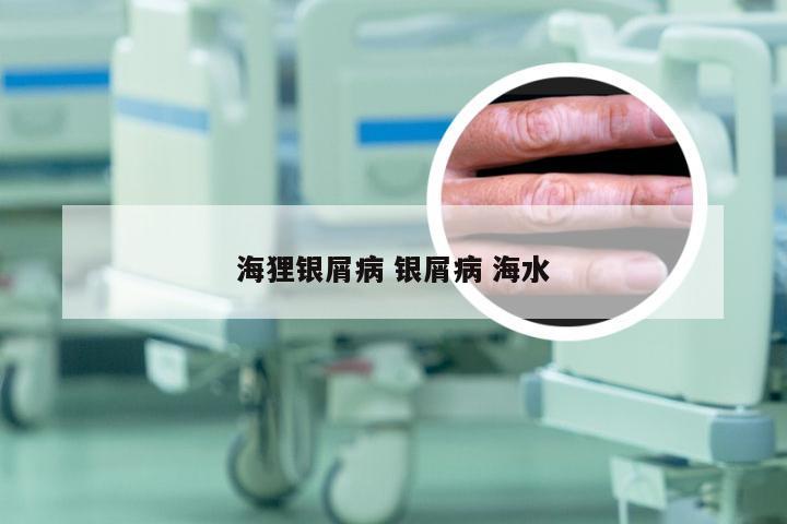 海狸银屑病 银屑病 海水
