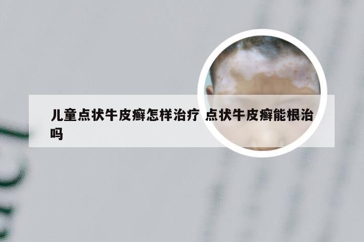 儿童点状牛皮癣怎样治疗 点状牛皮癣能根治吗