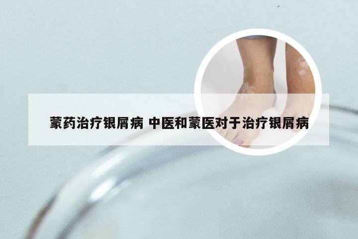 蒙药治疗银屑病 中医和蒙医对于治疗银屑病