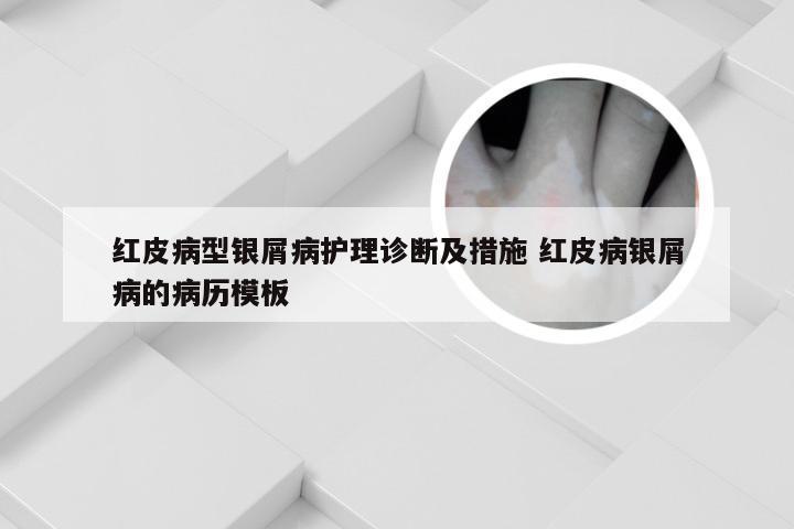 红皮病型银屑病护理诊断及措施 红皮病银屑病的病历模板
