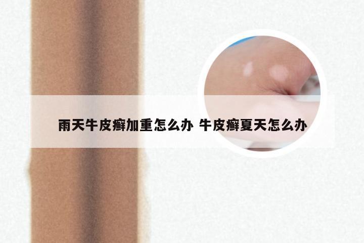 雨天牛皮癣加重怎么办 牛皮癣夏天怎么办