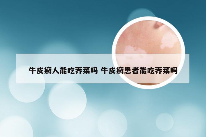 牛皮癣人能吃荠菜吗 牛皮癣患者能吃荠菜吗