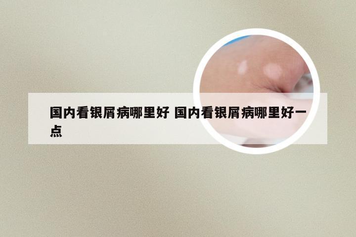国内看银屑病哪里好 国内看银屑病哪里好一点