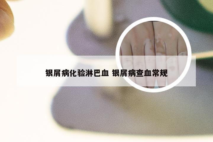 银屑病化验淋巴血 银屑病查血常规