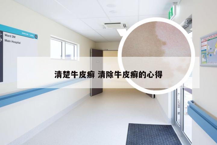清楚牛皮癣 清除牛皮癣的心得