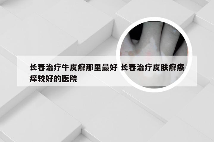 长春治疗牛皮癣那里最好 长春治疗皮肤癣瘙痒较好的医院