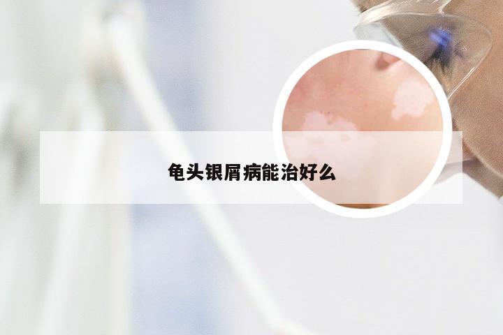 龟头银屑病能治好么