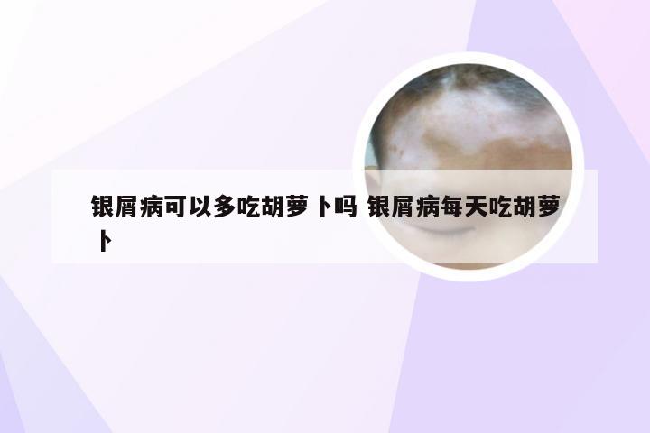 银屑病可以多吃胡萝卜吗 银屑病每天吃胡萝卜