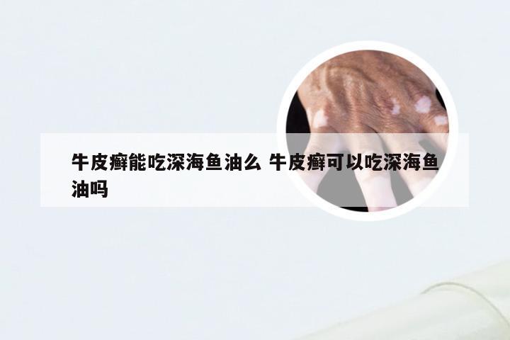 牛皮癣能吃深海鱼油么 牛皮癣可以吃深海鱼油吗