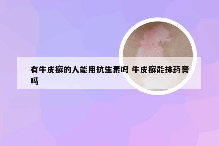 有牛皮癣的人能用抗生素吗 牛皮癣能抹药膏吗