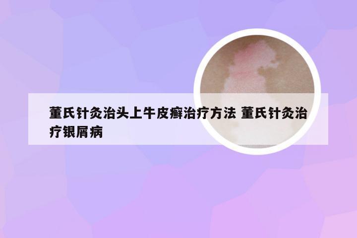 董氏针灸治头上牛皮癣治疗方法 董氏针灸治疗银屑病