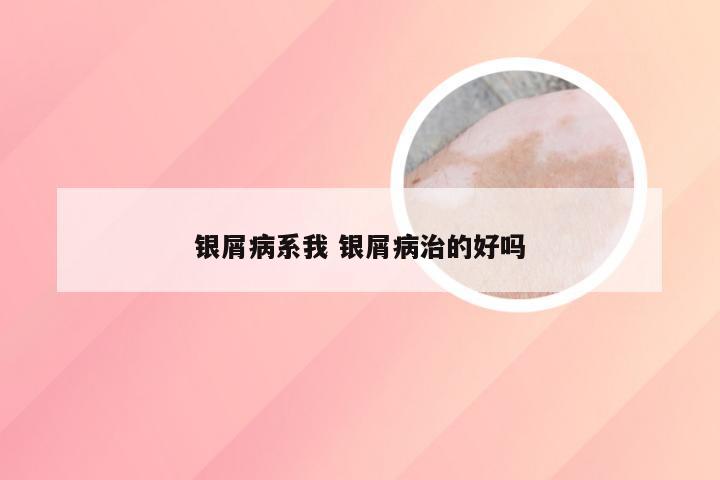 银屑病系我 银屑病治的好吗
