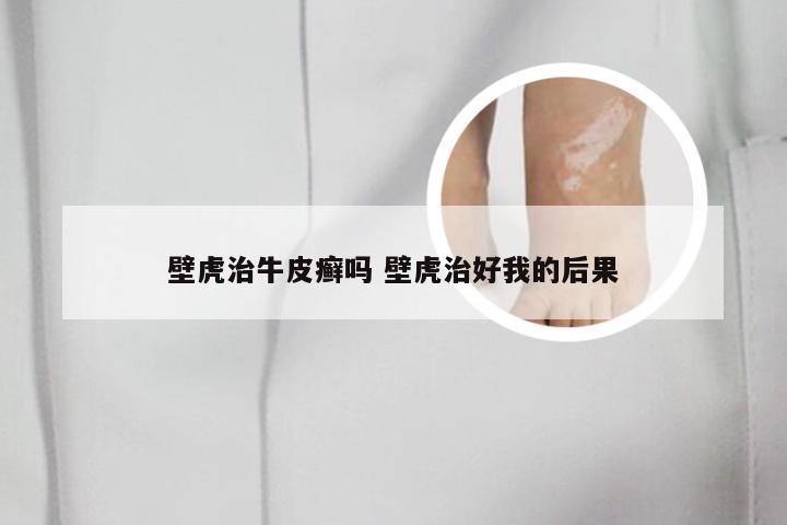 壁虎治牛皮癣吗 壁虎治好我的后果