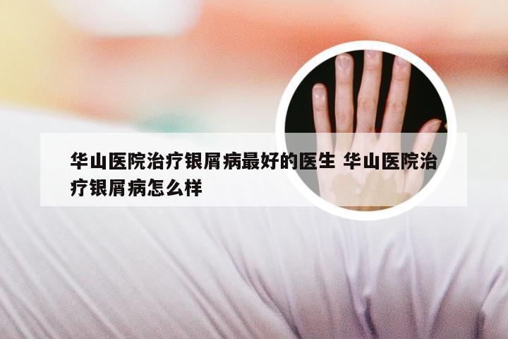 华山医院治疗银屑病最好的医生 华山医院治疗银屑病怎么样