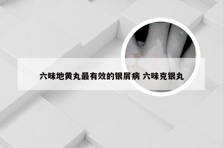 六味地黄丸最有效的银屑病 六味克银丸