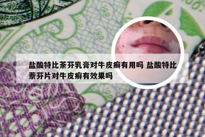 盐酸特比荼芬乳膏对牛皮癣有用吗 盐酸特比萘芬片对牛皮癣有效果吗