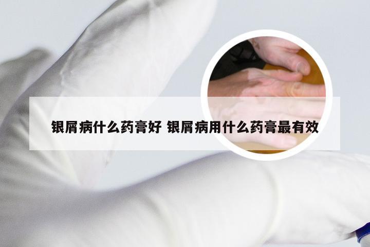 银屑病什么药膏好 银屑病用什么药膏最有效