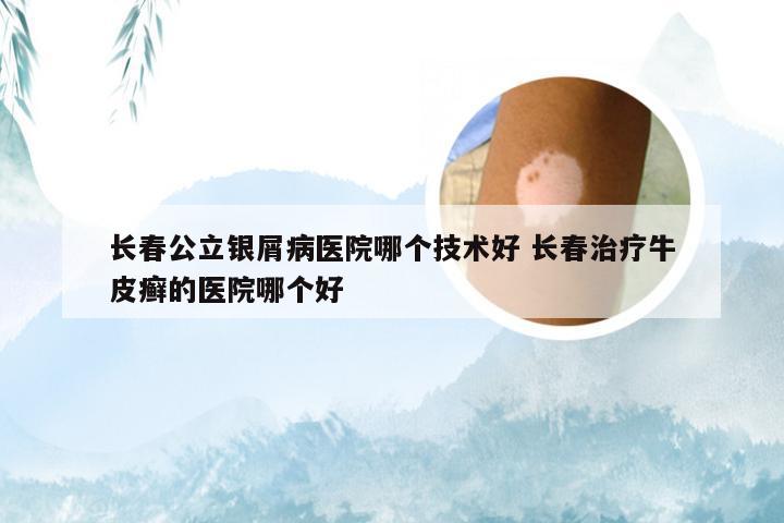 长春公立银屑病医院哪个技术好 长春治疗牛皮癣的医院哪个好