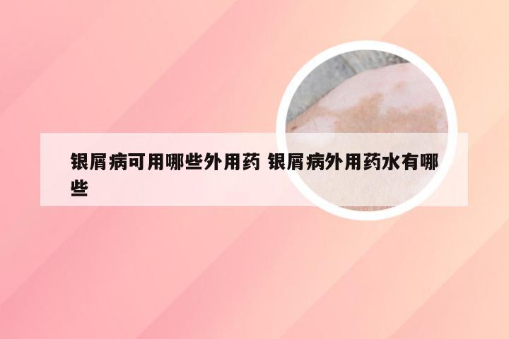 银屑病可用哪些外用药 银屑病外用药水有哪些