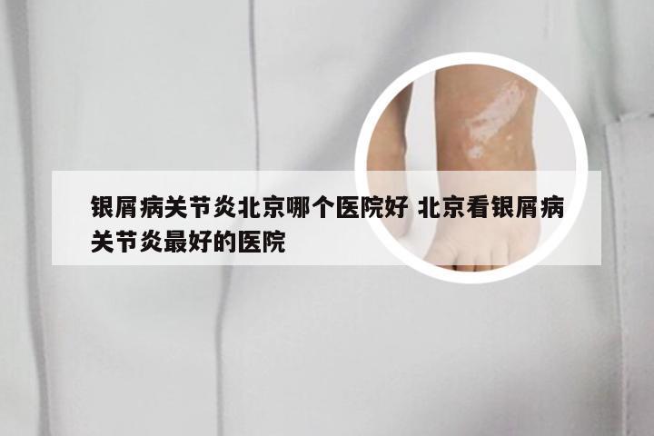 银屑病关节炎北京哪个医院好 北京看银屑病关节炎最好的医院