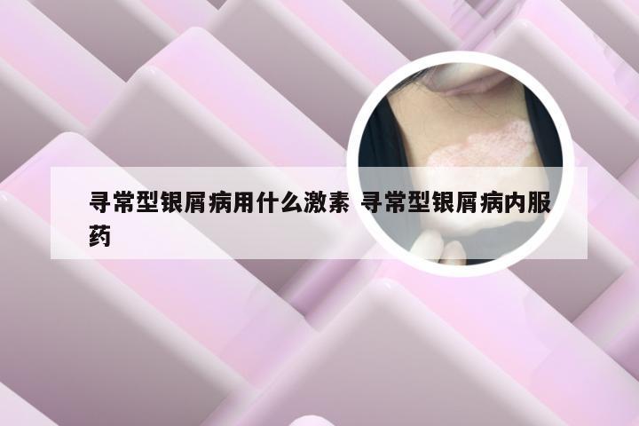 寻常型银屑病用什么激素 寻常型银屑病内服药