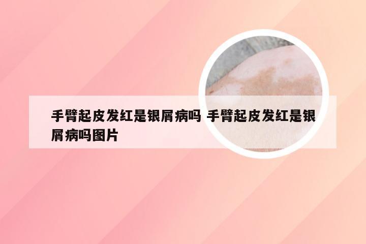 手臂起皮发红是银屑病吗 手臂起皮发红是银屑病吗图片