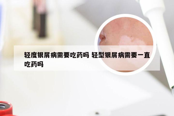 轻度银屑病需要吃药吗 轻型银屑病需要一直吃药吗
