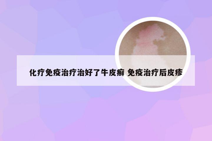 化疗免疫治疗治好了牛皮癣 免疫治疗后皮疹
