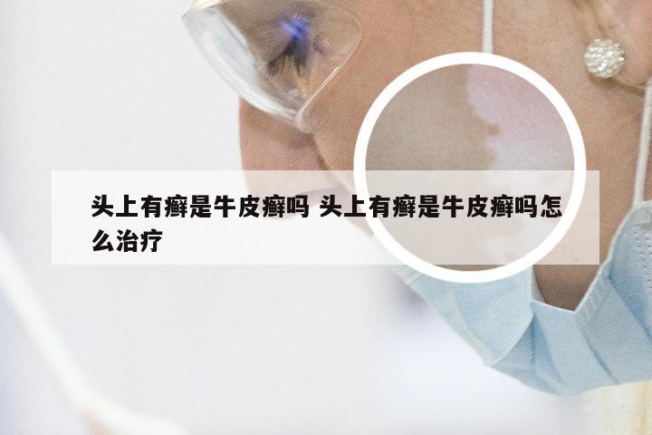 头上有癣是牛皮癣吗 头上有癣是牛皮癣吗怎么治疗