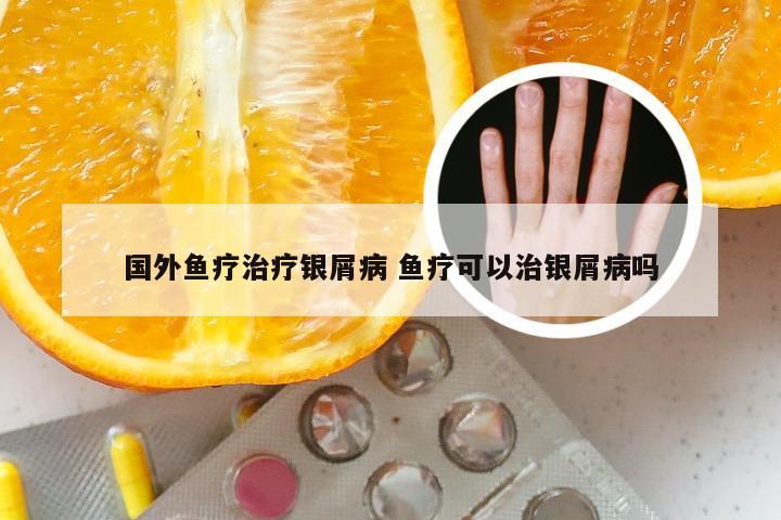 国外鱼疗治疗银屑病 鱼疗可以治银屑病吗
