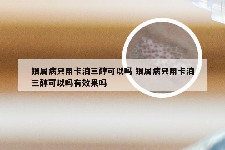 银屑病只用卡泊三醇可以吗 银屑病只用卡泊三醇可以吗有效果吗