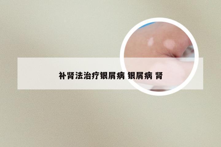 补肾法治疗银屑病 银屑病 肾