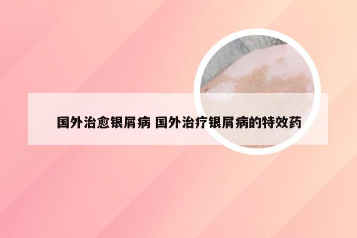 国外治愈银屑病 国外治疗银屑病的特效药