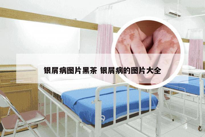 银屑病图片黑茶 银屑病的图片大全